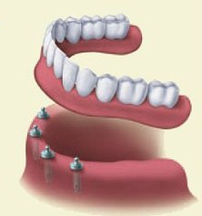 Dentures | Colton Family Dental | Devang J. Patel, D.D.S. | Colton, CA 92324