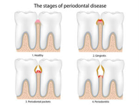 Gum Disease Treatment | Colton Family Dental | Devang J. Patel, D.D.S. | Colton, CA 92324