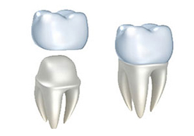 Dental Crowns | Colton Family Dental | Devang J. Patel, D.D.S. | Colton, CA 92324